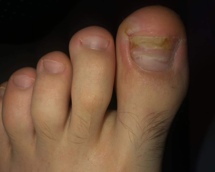 Med pedicure 